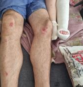 Bambina di 4 anni si frattura una gamba cadendo in un tombino mal sigillato